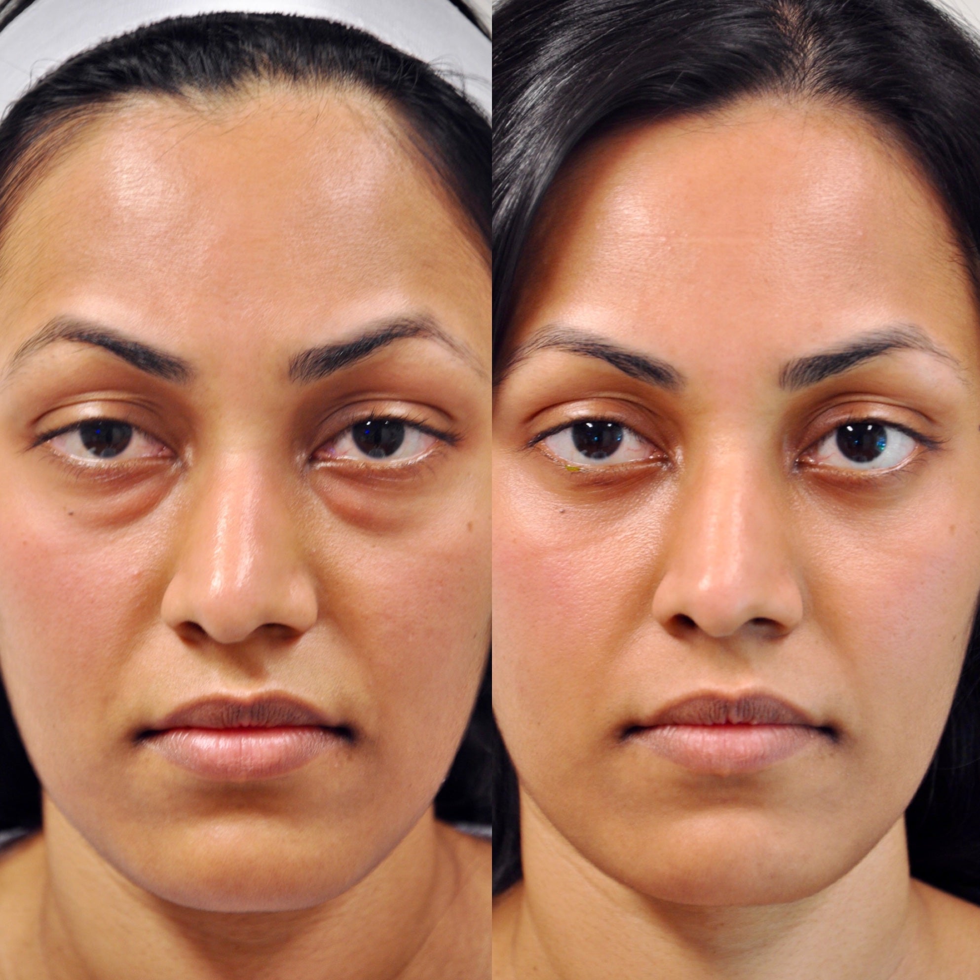 LOWER EYELID SURGERY (BLEPHAROPLASTY) BEFORE & AFTER PHOTO. SURGERY BY DR. BALJEET K. PUREWAL (OCULOPLASTIC SURGEON) IN NEW JERSEY