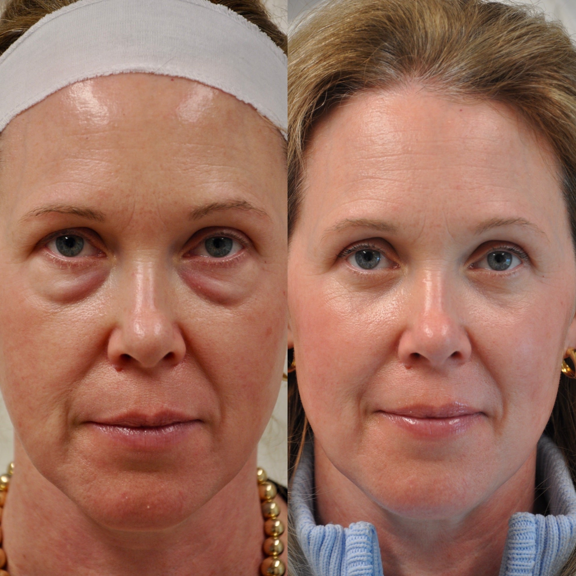 LOWER EYELID SURGERY (BLEPHAROPLASTY) BEFORE & AFTER PHOTO. SURGERY BY DR. BALJEET K. PUREWAL (OCULOPLASTIC SURGEON) IN NEW JERSEY