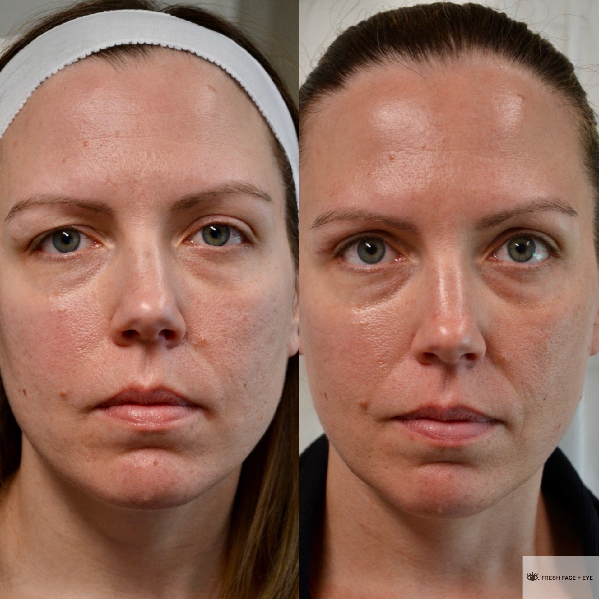 UPPER EYELID SURGERY (BLEPHAROPLASTY) BEFORE & AFTER PHOTO. SURGERY BY DR. BALJEET K. PUREWAL (OCULOPLASTIC SURGEON) IN NEW JERSEY.