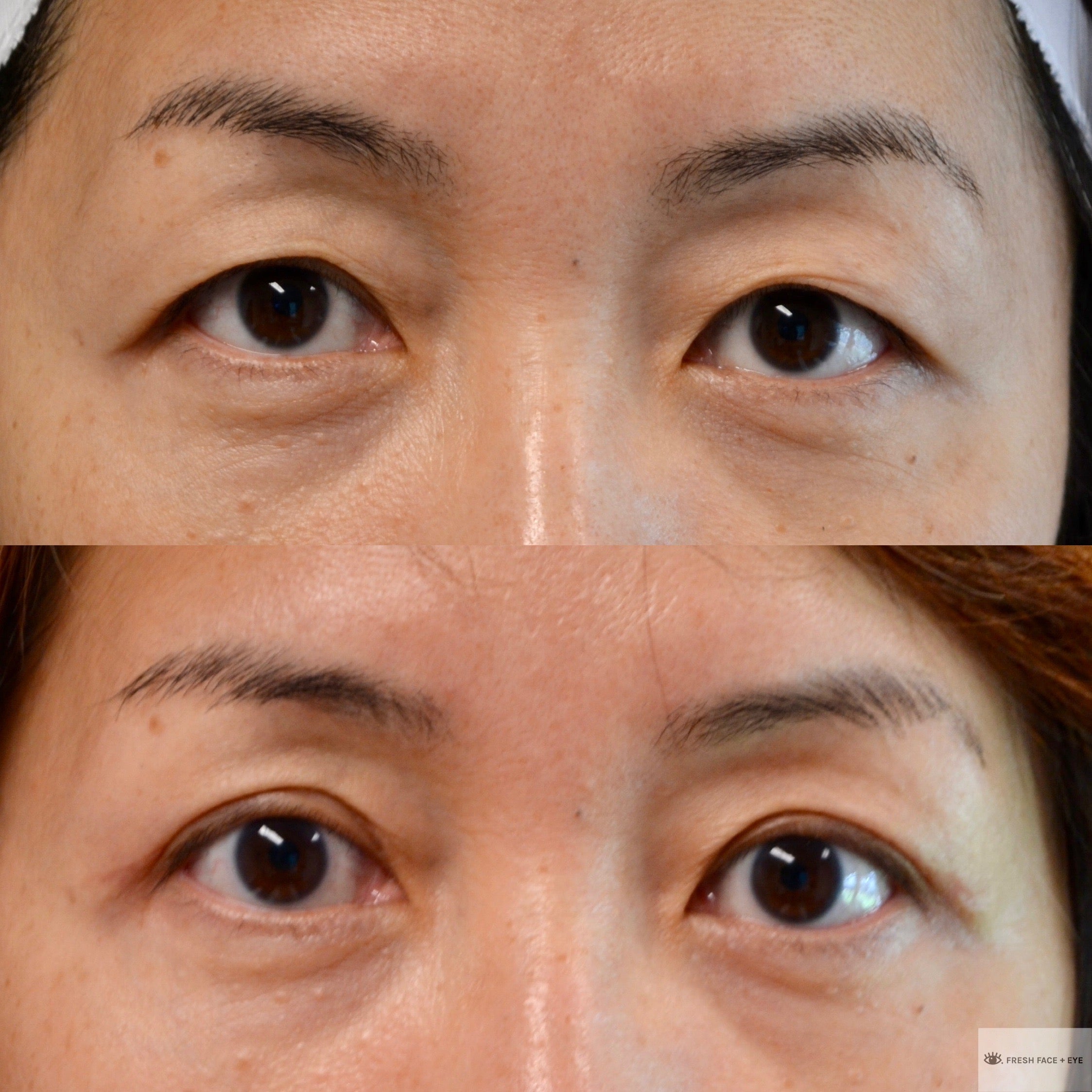 UPPER EYELID SURGERY (BLEPHAROPLASTY) BEFORE & AFTER PHOTO. SURGERY BY DR. BALJEET K. PUREWAL (OCULOPLASTIC SURGEON) IN NEW JERSEY.