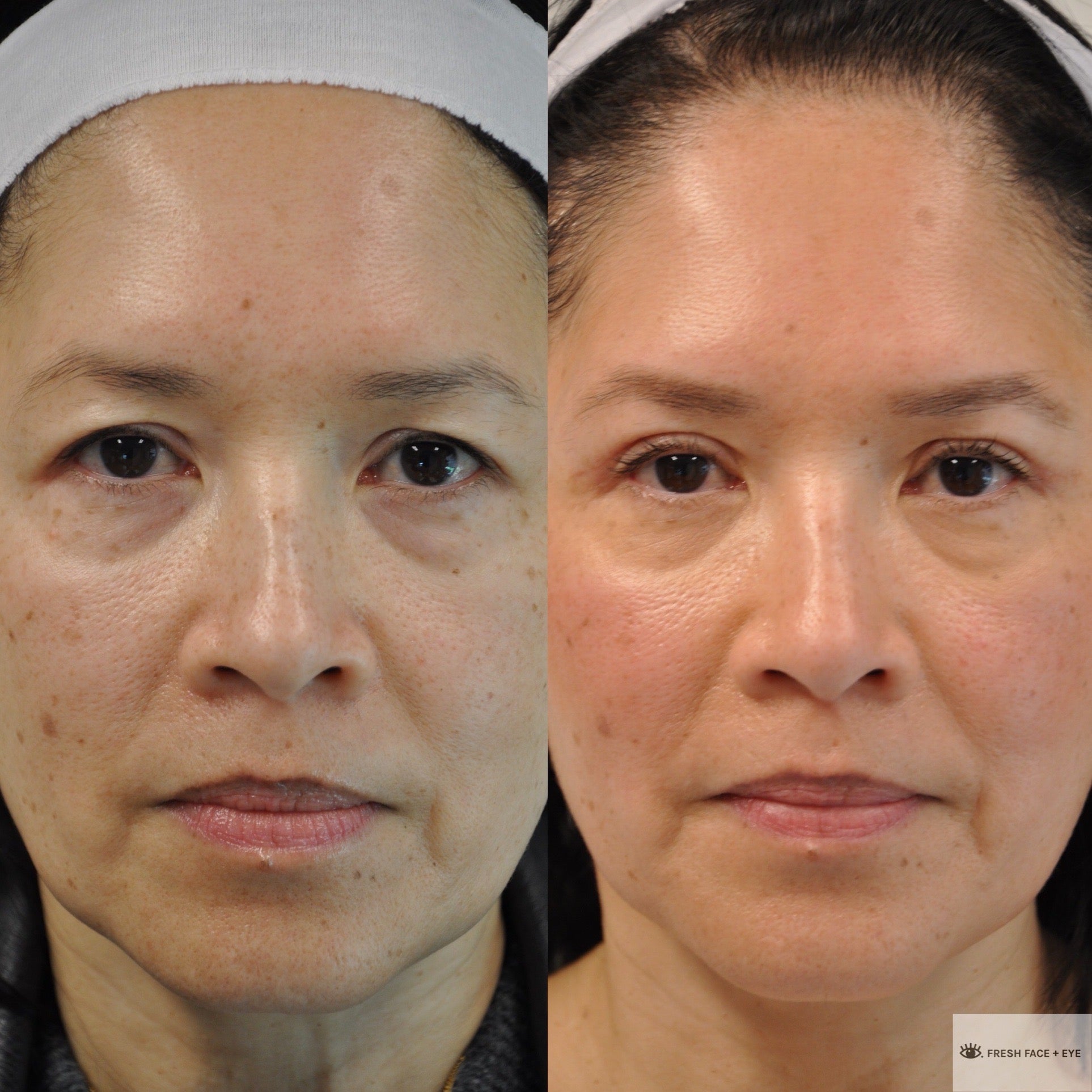 UPPER EYELID SURGERY (BLEPHAROPLASTY) BEFORE & AFTER PHOTO. SURGERY BY DR. BALJEET K. PUREWAL (OCULOPLASTIC SURGEON) IN NEW JERSEY.