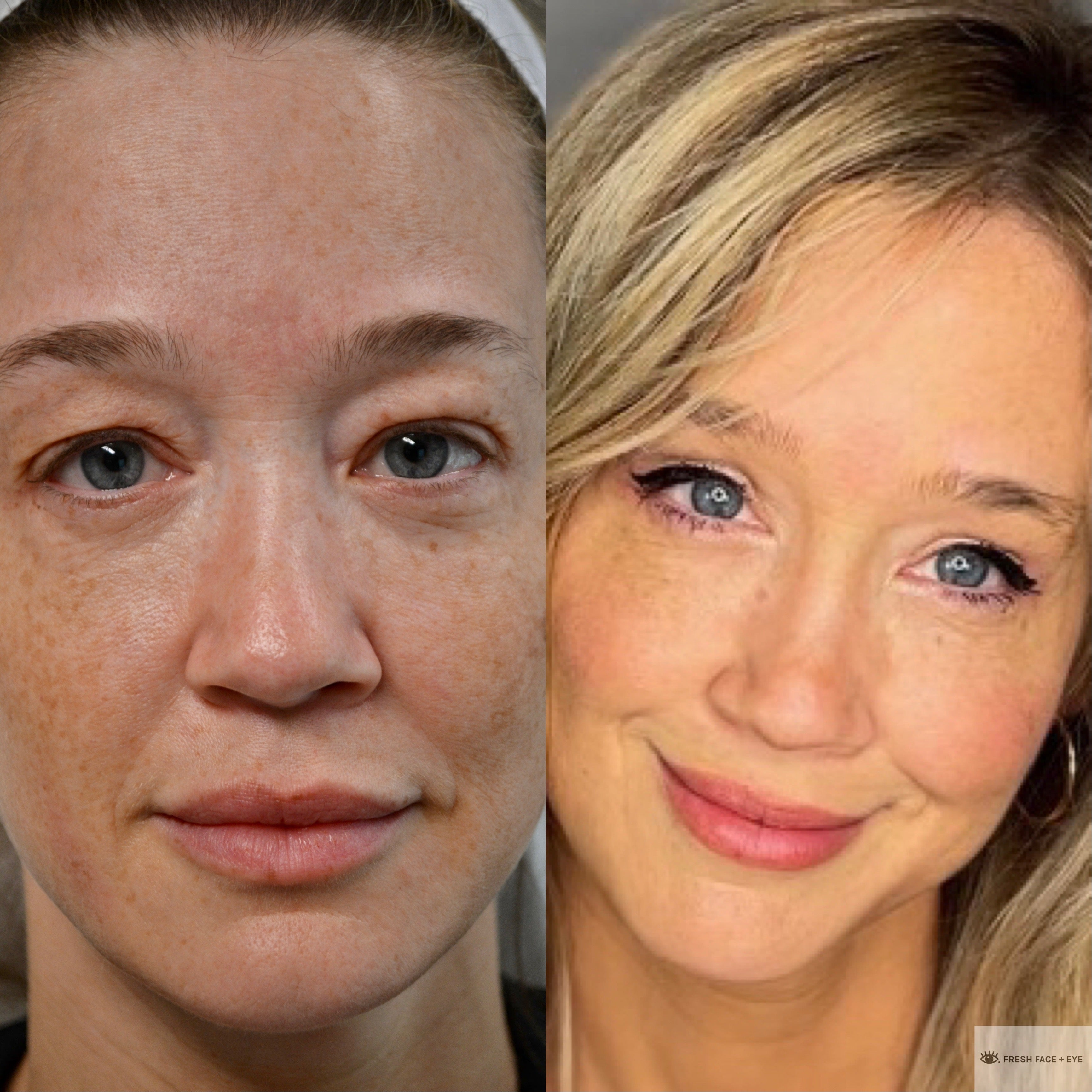 UPPER EYELID SURGERY (BLEPHAROPLASTY) BEFORE & AFTER PHOTO. SURGERY BY DR. BALJEET K. PUREWAL (OCULOPLASTIC SURGEON) IN NEW JERSEY.