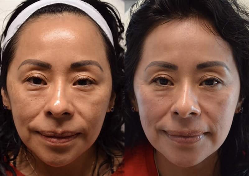 CHEMICAL PEEL BEFORE & AFTER PHOTO. PROCEDURE BY DR. BALJEET K. PUREWAL (OCULOPLASTIC SURGEON) IN NEW JERSEy.