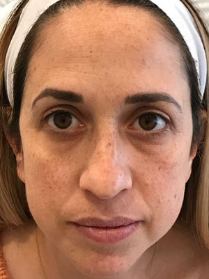 Broadband Light (BBL) Photofacial Healing Case: Before