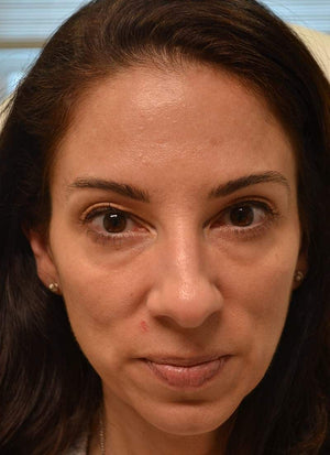 Upper Eyelid Surgery Healing Case: Before