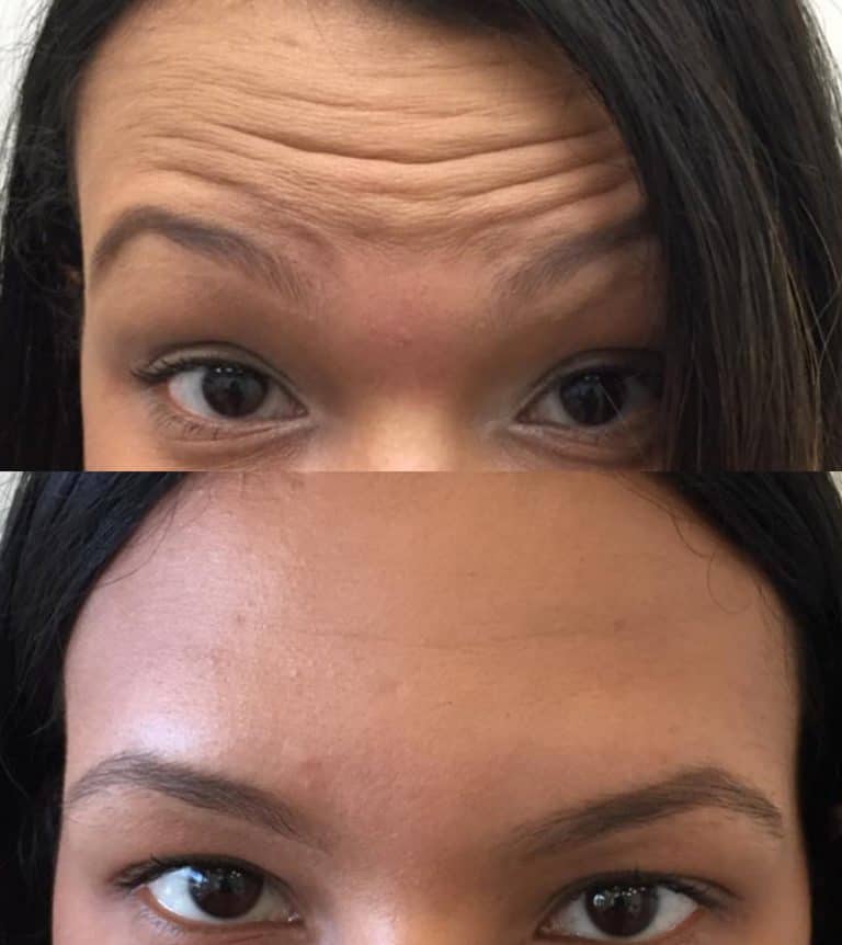 BOTOX BEFORE & AFTER PHOTO. PROCEDURE BY DR. BALJEET K. PUREWAL (OCULOPLASTIC SURGEON) IN NEW JERSEY.