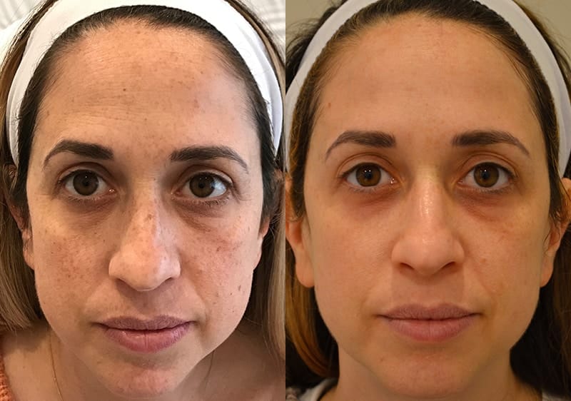 BBL PHOTOFACIAL BEFORE & AFTER PHOTO. PROCEDURE PERFORMED BY DR. BALJEET K. PUREWAL (OCULOPLASTIC SURGEON) IN NEW JERSEY.