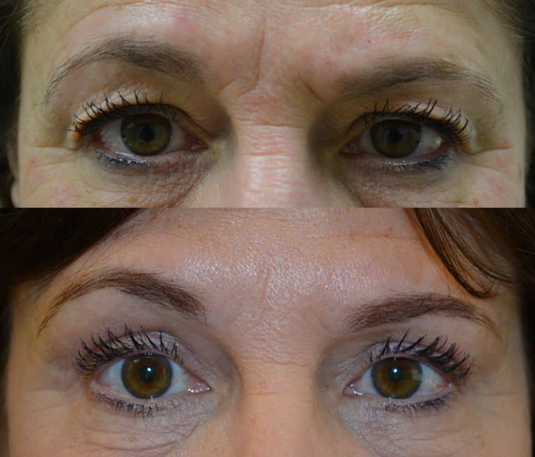 UPPER EYELID SURGERY (BLEPHAROPLASTY) BEFORE & AFTER PHOTO. SURGERY BY DR. BALJEET K. PUREWAL (OCULOPLASTIC SURGEON) IN NEW JERSEY.