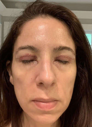 Upper Eyelid Surgery Healing Case: Day 1