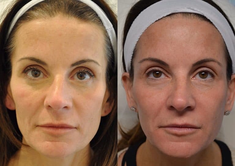 DERMAL FILLER BEFORE & AFTER PHOTO. PROCEDURE BY DR. BALJEET K. PUREWAL (OCULOPLASTIC SURGEON) IN NEW JERSEY.