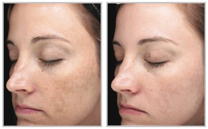 HALO LASER BEFORE & AFTER PHOTO