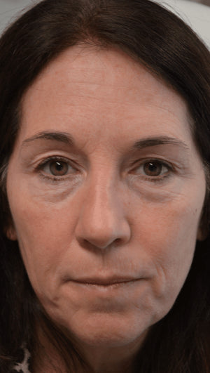 Eyelid Surgery Healing Case: Before