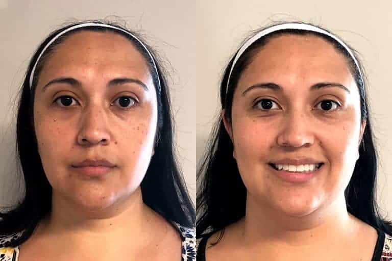 MICRONEEDLING BEFORE & AFTER PHOTO. PROCEDURE BY DR. BALJEET K. PUREWAL (OCULOPLASTIC SURGEON) IN NEW JERSEY.