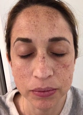 Broadband Light (BBL) Photofacial Healing Case: Day 1