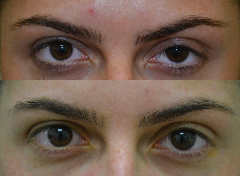 PTOSIS REPAIR BEFORE & AFTER PHOTO. PROCEDURE BY DR. BALJEET K. PUREWAL (OCULOPLASTIC SURGEON) IN NEW JERSEY.