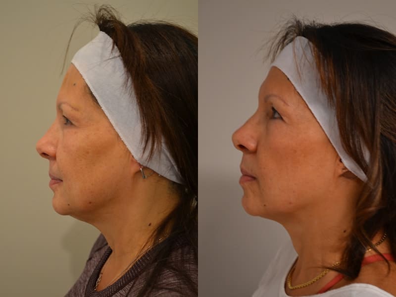 ULTHERAPY BEFORE & AFTER PHOTO. PROCEDURE BY DR. BALJEET K. PUREWAL (OCULOPLASTIC SURGEON) IN NEW JERSEY.