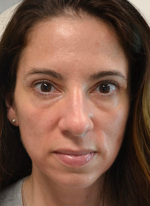 Upper Eyelid Surgery Healing Case: Day 7