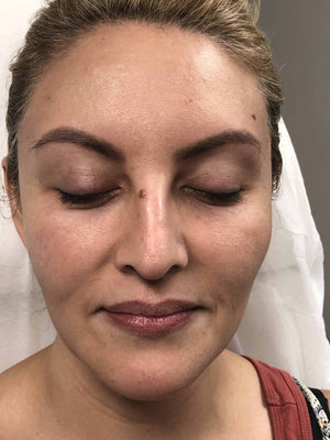 HALO LASER Treatment Healing Case: Before Procedure