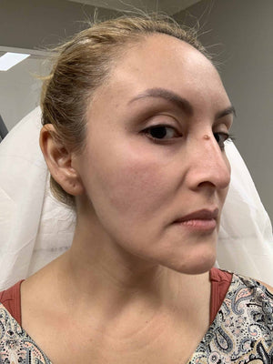 HALO LASER Treatment Healing Case: Before Right-side