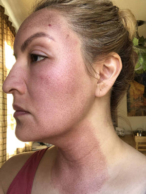 HALO LASER Treatment Healing Case: 1 Day After Left-side