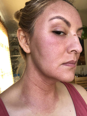 HALO LASER Treatment Healing Case: 1 Day After Right-side