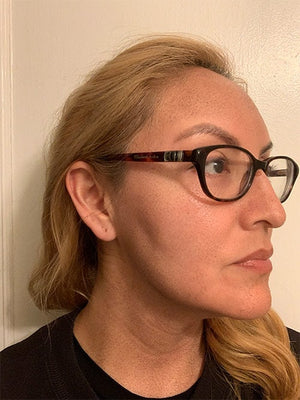 HALO LASER Treatment Healing Case: 4 Days After Right-side