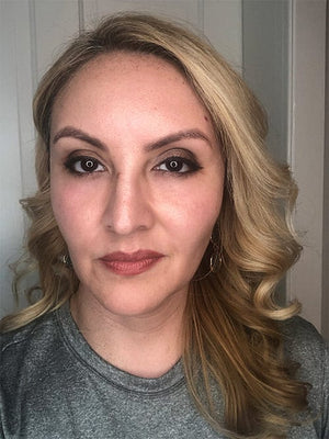 HALO LASER Treatment Healing Case: 6 Days After Full Face