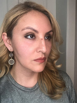 HALO LASER Treatment Healing Case: 6 Days After Right-side