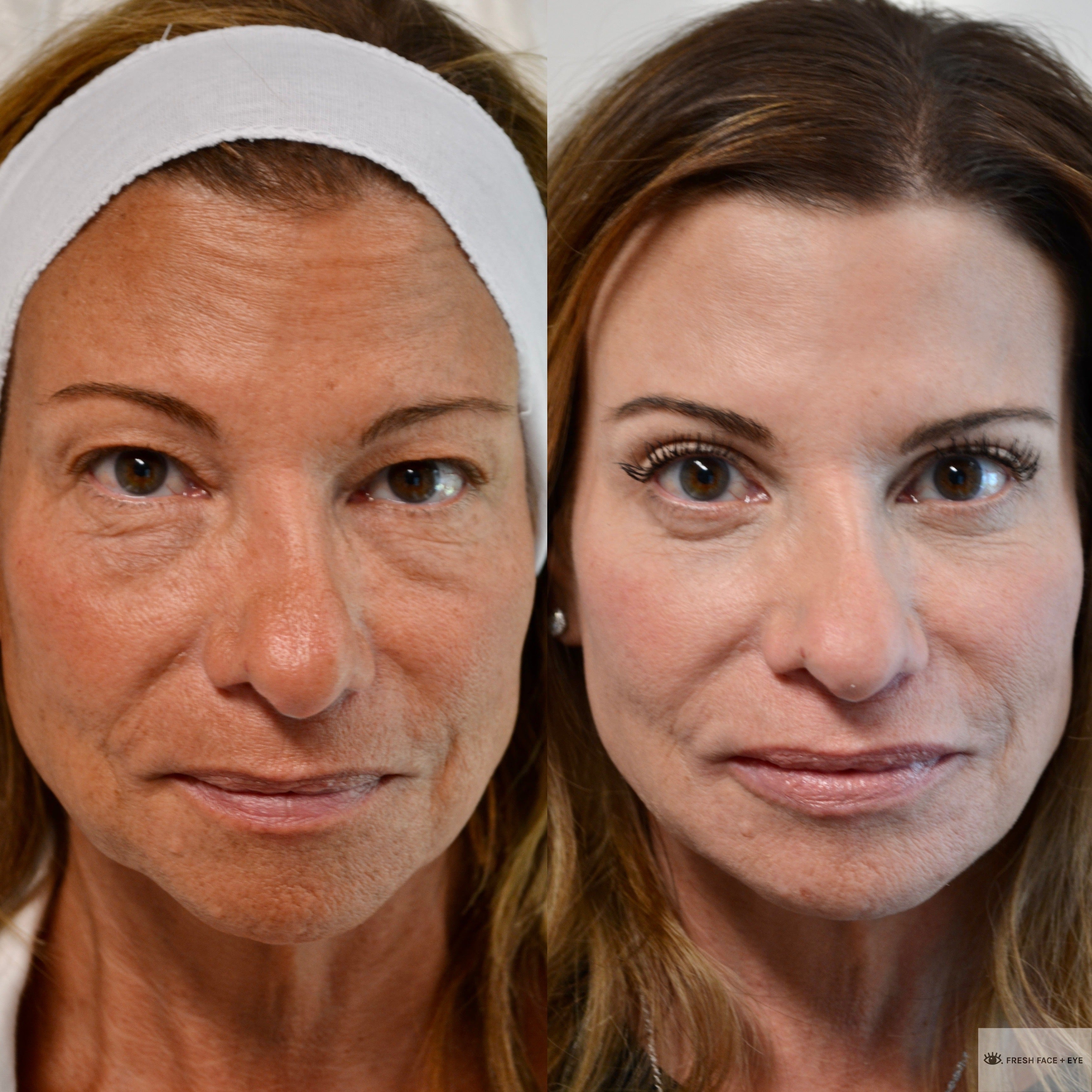 COMBINATION THERAPY BEFORE & AFTER PHOTO. PROCEDURE BY DR. BALJEET K. PUREWAL (OCULOPLASTIC SURGEON) IN NEW JERSEY.