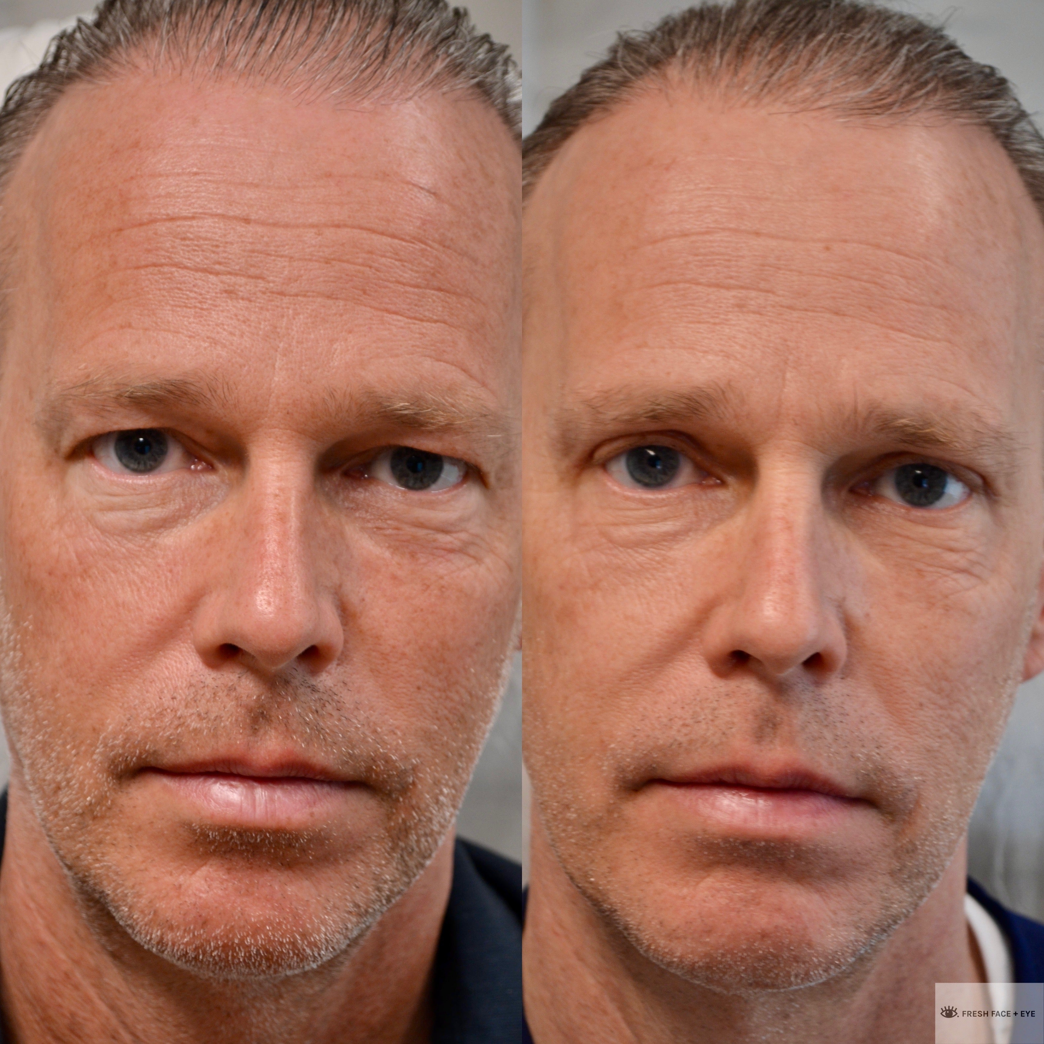 UPPER EYELID SURGERY (BLEPHAROPLASTY) BEFORE & AFTER PHOTO. SURGERY BY DR. BALJEET K. PUREWAL (OCULOPLASTIC SURGEON) IN NEW JERSEY.