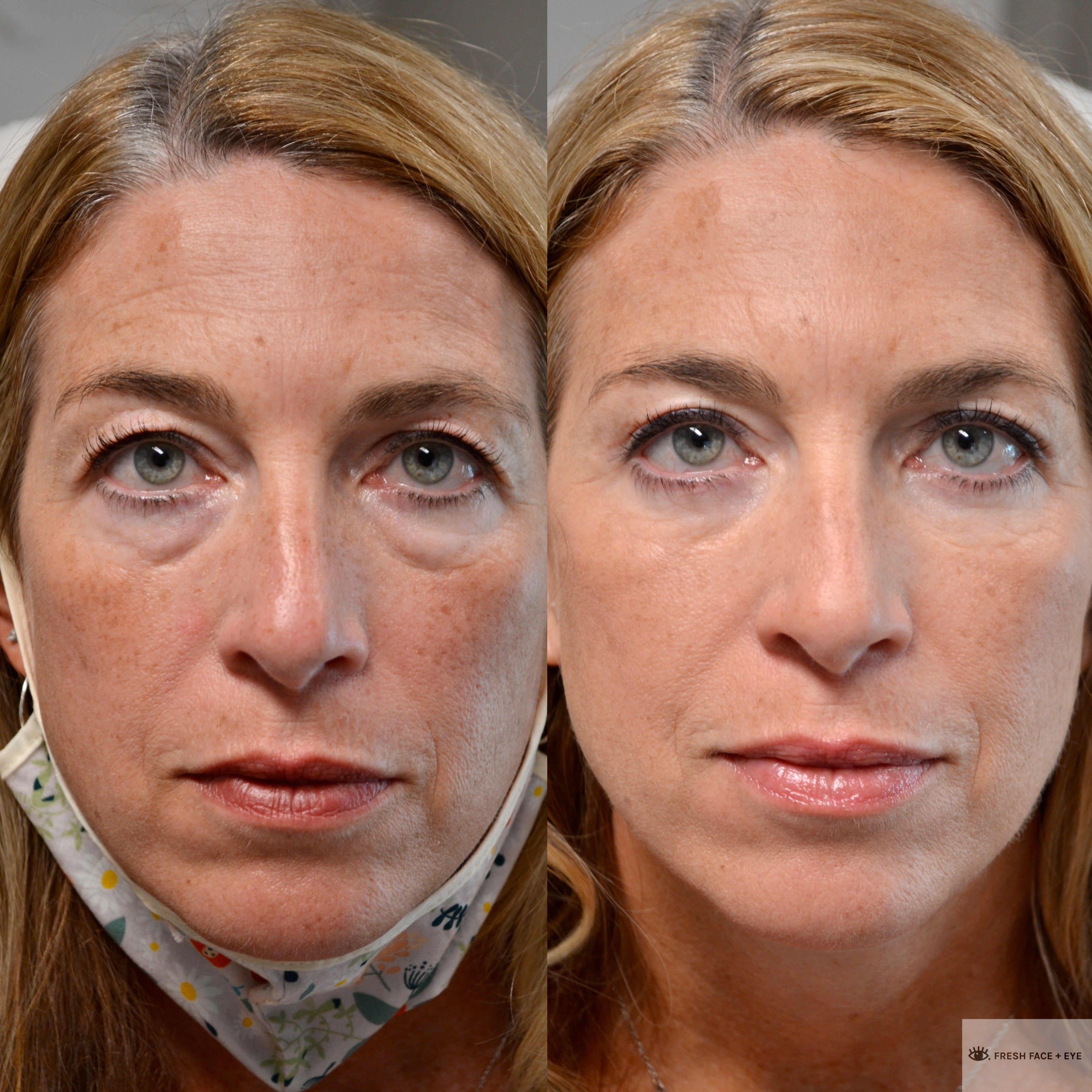 UPPER & LOWER EYELID SURGERY (BLEPHAROPLASTY) BEFORE & AFTER PHOTO. SURGERY BY DR. BALJEET K. PUREWAL (OCULOPLASTIC SURGEON) IN NEW JERSEY.