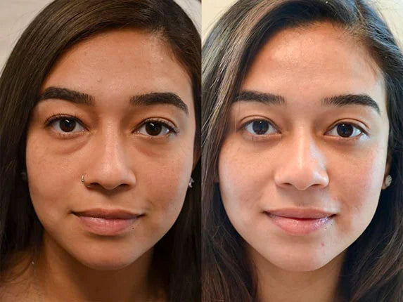 LOWER EYELID SURGERY (BLEPHAROPLASTY) BEFORE & AFTER PHOTO. SURGERY BY DR. BALJEET K. PUREWAL (OCULOPLASTIC SURGEON) IN NEW JERSEY