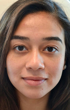 Lower Eyelid Surgery Healing Case: Day 90