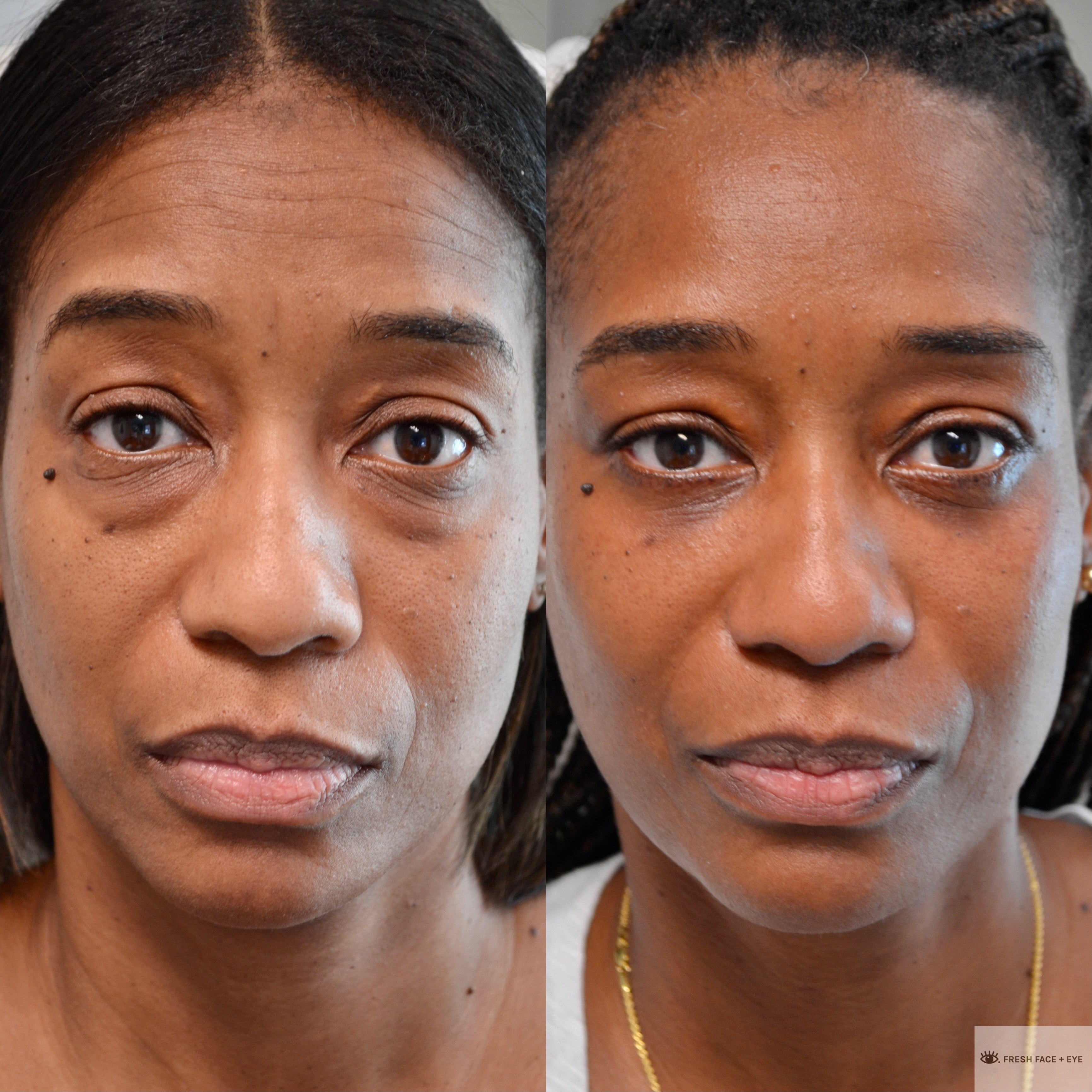 LOWER EYELID SURGERY (BLEPHAROPLASTY) BEFORE & AFTER PHOTO. SURGERY BY DR. BALJEET K. PUREWAL (OCULOPLASTIC SURGEON) IN NEW JERSEY.