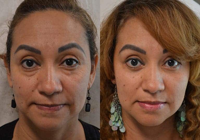 LOWER EYELID SURGERY (BLEPHAROPLASTY) BEFORE & AFTER PHOTO. SURGERY BY DR. BALJEET K. PUREWAL (OCULOPLASTIC SURGEON) IN NEW JERSEY.