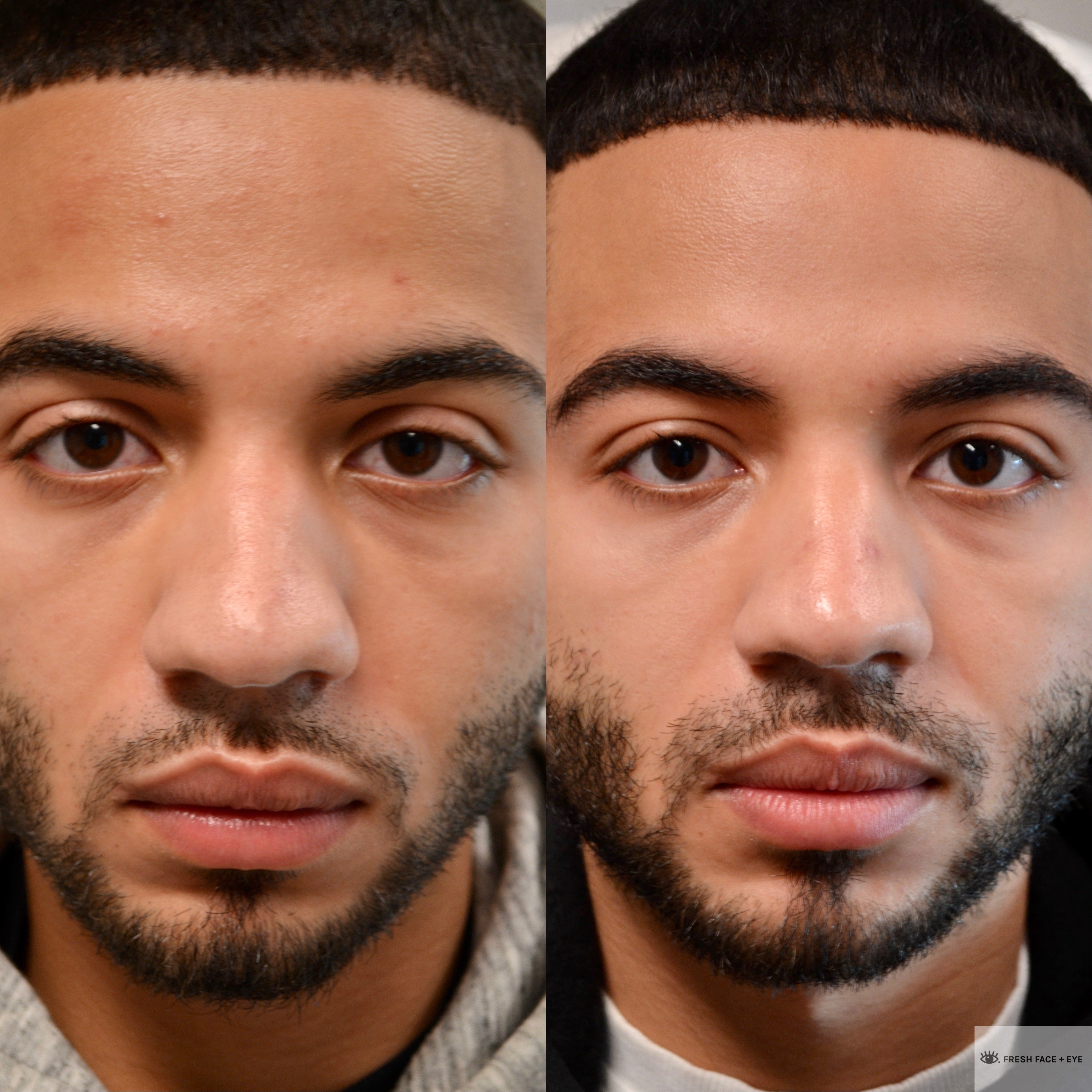 PTOSIS REPAIR BEFORE & AFTER PHOTO. PROCEDURE BY DR. BALJEET K. PUREWAL (OCULOPLASTIC SURGEON) IN NEW JERSEY.