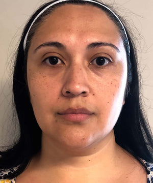 Microneedling Treatment Healing Case: Before