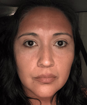 Microneedling Treatment Healing Case: Day 1 (with makeup)