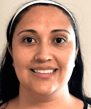 Microneedling Treatment Healing Case: Day 7