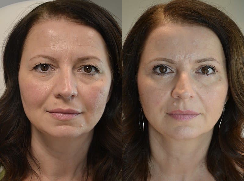 UPPER EYELID SURGERY (BLEPHAROPLASTY) BEFORE & AFTER PHOTO. SURGERY BY DR. BALJEET K. PUREWAL (OCULOPLASTIC SURGEON) IN NEW JERSEY.