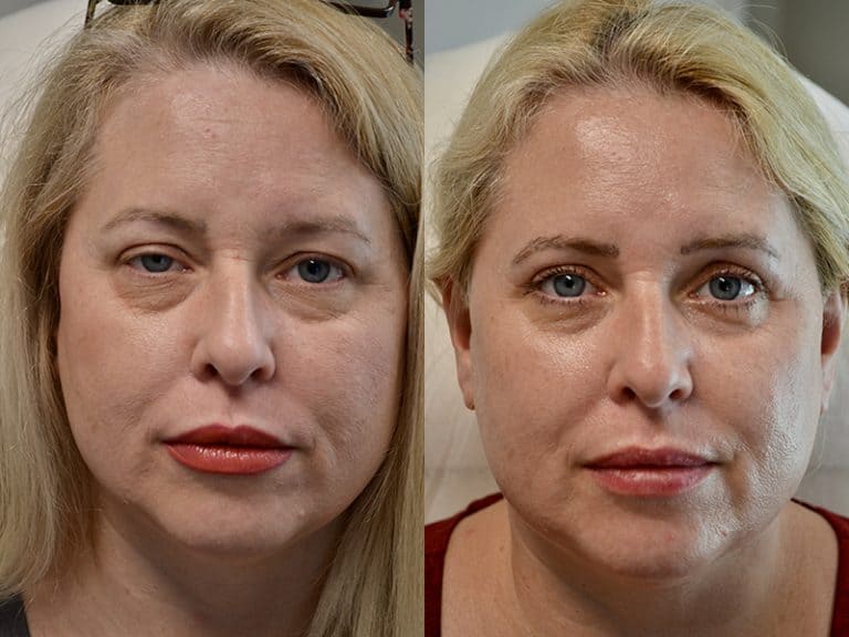 UPPER EYELID SURGERY (BLEPHAROPLASTY) BEFORE & AFTER PHOTO. SURGERY BY DR. BALJEET K. PUREWAL (OCULOPLASTIC SURGEON) IN NEW JERSEY.