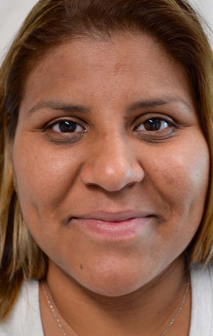 Ptosis Repair Healing Case: Day 30