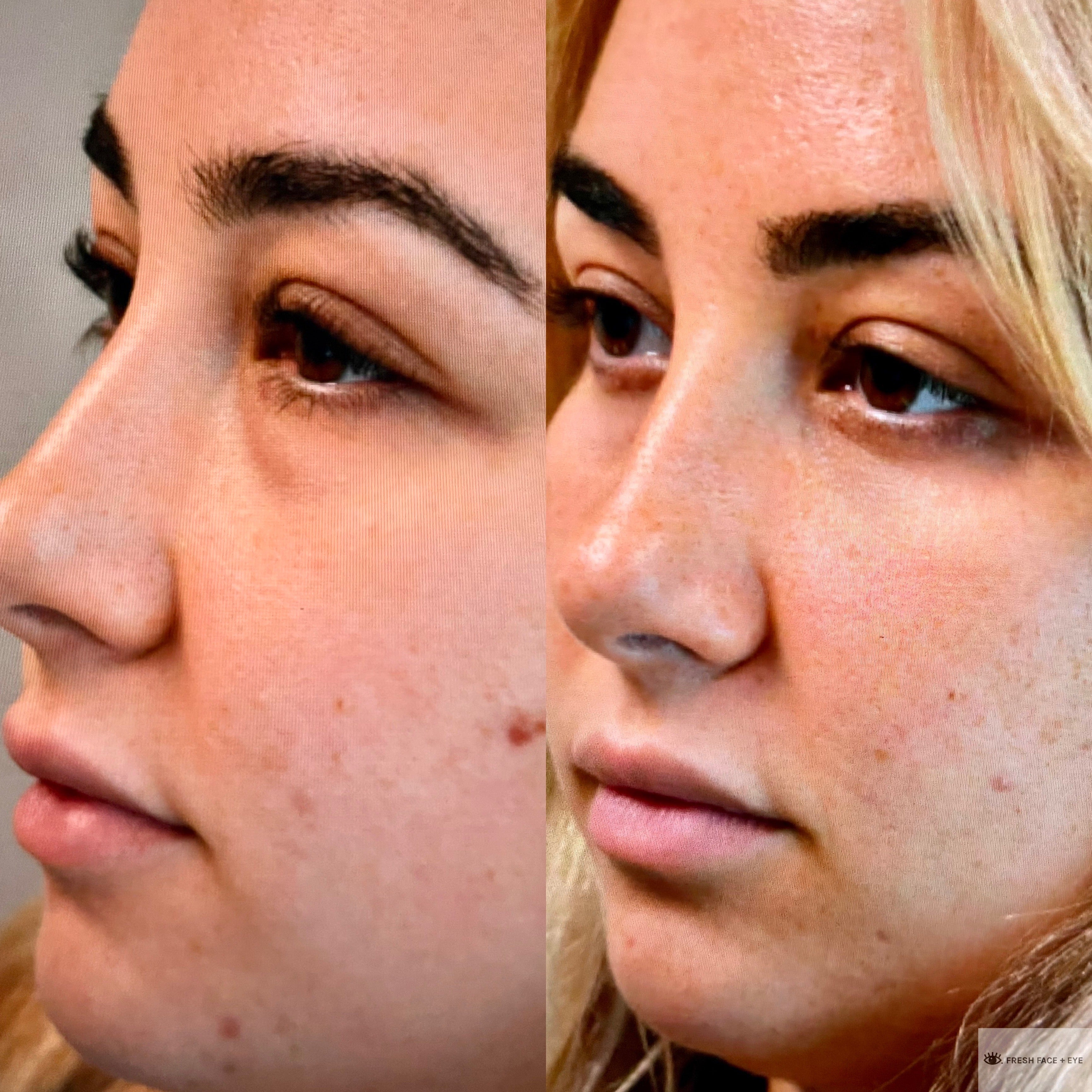 LOWER EYELID SURGERY (BLEPHAROPLASTY) BEFORE & AFTER PHOTO. SURGERY BY DR. BALJEET K. PUREWAL (OCULOPLASTIC SURGEON) IN NEW JERSEY.