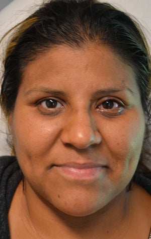 Ptosis Repair Healing Case: Immediately After