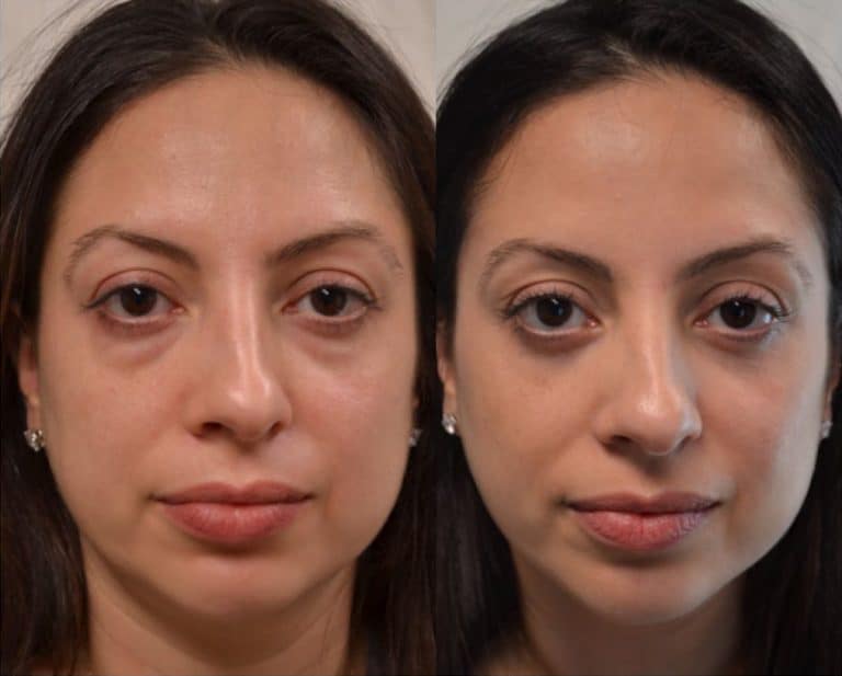 LOWER EYELID SURGERY (BLEPHAROPLASTY) BEFORE & AFTER PHOTO. SURGERY BY DR. BALJEET K. PUREWAL (OCULOPLASTIC SURGEON) IN NEW JERSEY.