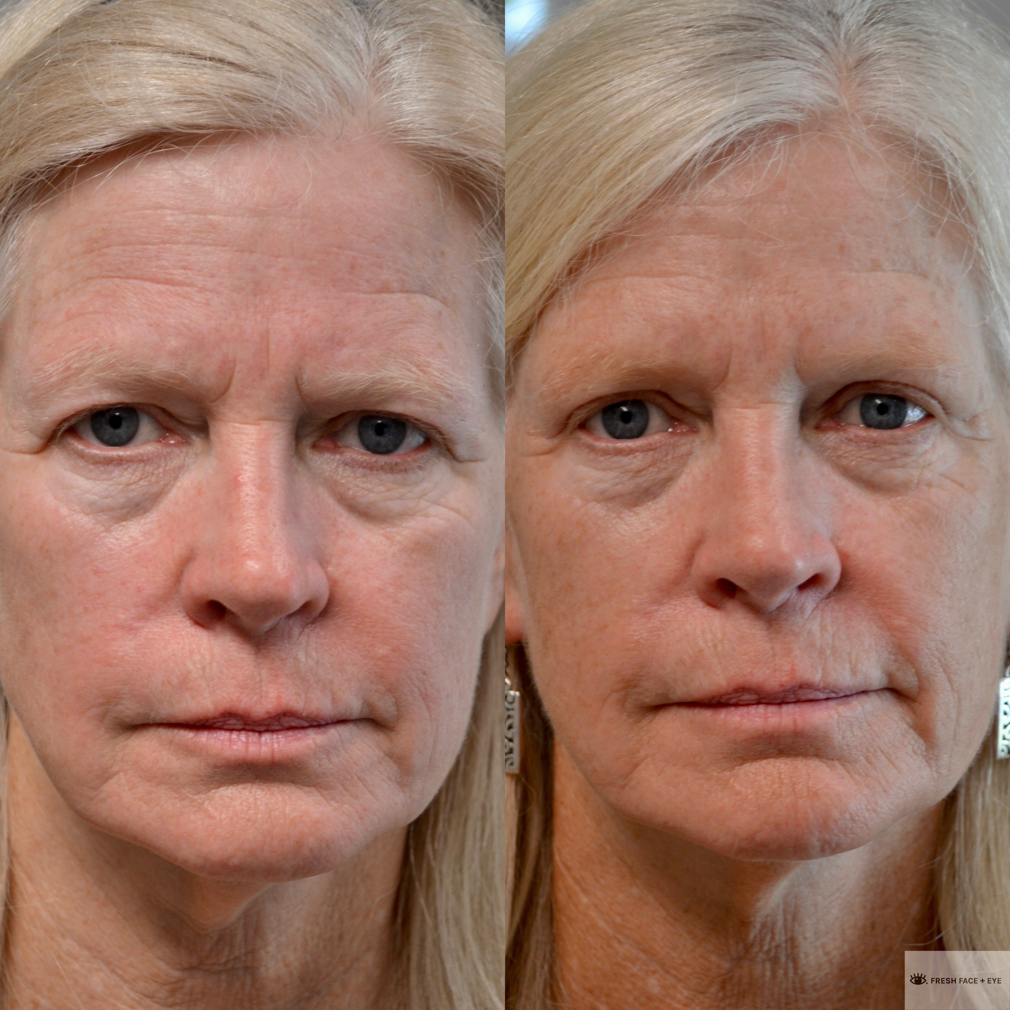 UPPER EYELID SURGERY (BLEPHAROPLASTY) BEFORE & AFTER PHOTO. SURGERY BY DR. BALJEET K. PUREWAL (OCULOPLASTIC SURGEON) IN NEW JERSEY.