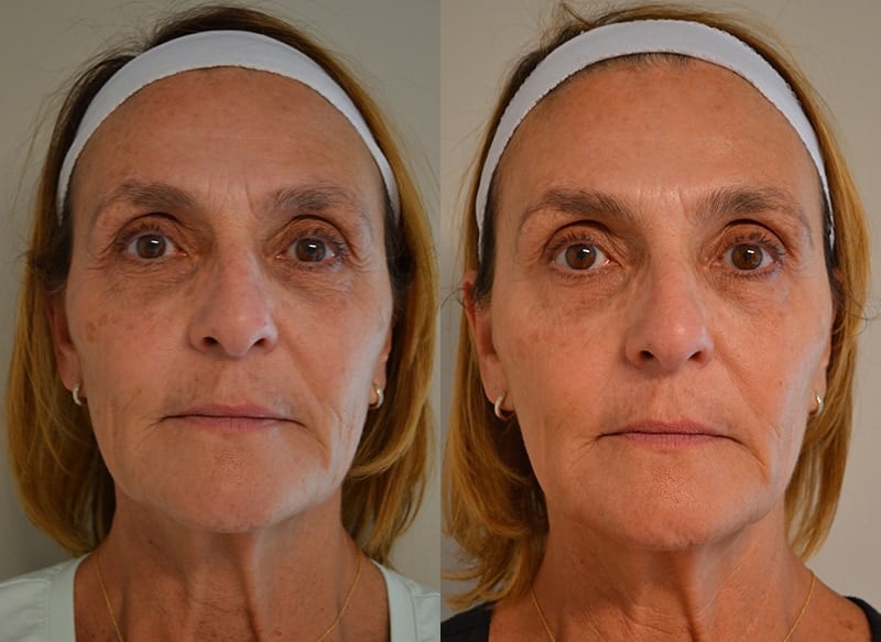 BBL PHOTOFACIAL BEFORE & AFTER PHOTO. PROCEDURE PERFORMED BY DR. BALJEET K. PUREWAL (OCULOPLASTIC SURGEON) IN NEW JERSEY.