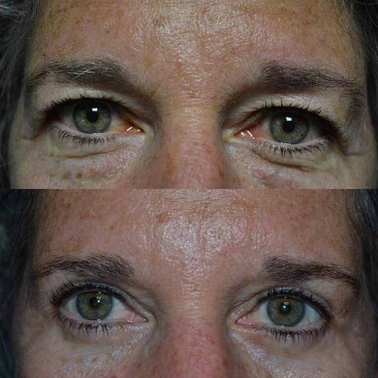 UPPER & LOWER EYELID SURGERY (BLEPHAROPLASTY) BEFORE & AFTER PHOTO. SURGERY BY DR. BALJEET K. PUREWAL (OCULOPLASTIC SURGEON) IN NEW JERSEY.