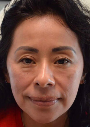 Chemical Peel Healing Case: Day 30