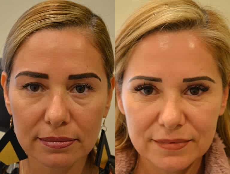 UPPER EYELID SURGERY (BLEPHAROPLASTY) BEFORE & AFTER PHOTO. SURGERY BY DR. BALJEET K. PUREWAL (OCULOPLASTIC SURGEON) IN NEW JERSEY.